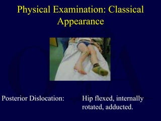 Physical Examination: Classical
Appearance
Posterior Dislocation: Hip flexed, internally
rotated, adducted.
 