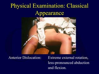 Physical Examination: Classical
Appearance
Anterior Dislocation: Extreme external rotation,
less-pronounced abduction
and flexion.
 
