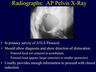 Radiographs: AP Pelvis X-Ray
• In primary survey of ATLS Protocol.
• Should allow diagnosis and show direction of dislocation.
– Femoral head not centered in acetabulum.
– Femoral head appears larger (anterior) or smaller (posterior).
• Usually provides enough information to proceed with closed
reduction.
 
