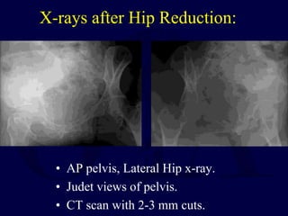 X-rays after Hip Reduction:
• AP pelvis, Lateral Hip x-ray.
• Judet views of pelvis.
• CT scan with 2-3 mm cuts.
 
