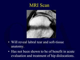 MRI Scan
• Will reveal labral tear and soft-tissue
anatomy.
• Has not been shown to be of benefit in acute
evaluation and treatment of hip dislocations.
 