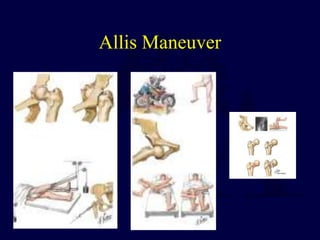 Allis Maneuver
 