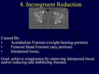 4. Incongruent Reduction
Caused By:
• Acetabulum Fracture (weight-bearing portion).
• Femoral Head Fracture (any portion).
• Interposed tissue.
Goal: achieve congruence by removing interposed tissue
and/or reducing and stabilizing fracture.
 