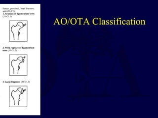 AO/OTA Classification
 
