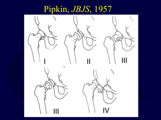 Pipkin, JBJS, 1957
 