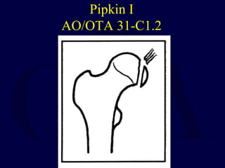 Pipkin I
AO/OTA 31-C1.2
 