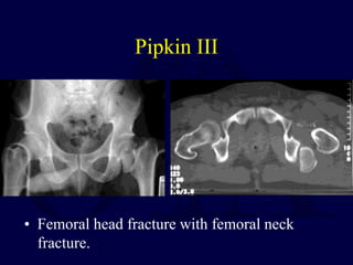 Pipkin III
• Femoral head fracture with femoral neck
fracture.
 