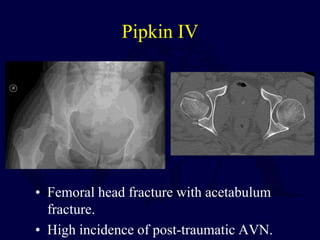 Pipkin IV
• Femoral head fracture with acetabulum
fracture.
• High incidence of post-traumatic AVN.
 