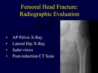Femoral Head Fracture:
Radiographic Evaluation
• AP Pelvis X-Ray
• Lateral Hip X-Ray
• Judet views
• Post-reduction CT Scan
 