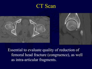 CT Scan
Essential to evaluate quality of reduction of
femoral head fracture (congruence), as well
as intra-articular fragments.
 