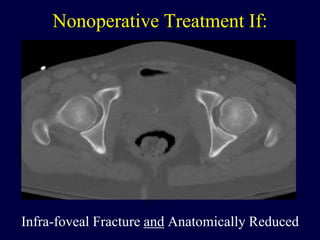 Nonoperative Treatment If:
Infra-foveal Fracture and Anatomically Reduced
 