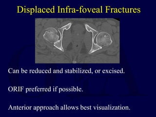 Displaced Infra-foveal Fractures
Can be reduced and stabilized, or excised.
ORIF preferred if possible.
Anterior approach allows best visualization.
 