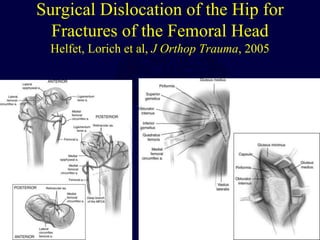 Surgical Dislocation of the Hip for
Fractures of the Femoral Head
Helfet, Lorich et al, J Orthop Trauma, 2005
 