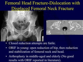 Femoral Head Fracture-Dislocation with
Displaced Femoral Neck Fracture
• Closed reduction attempts are futile.
• ORIF in young: open reduction of hip, then reduction
and stabilization of femoral neck and head.
• Arthroplasty in middle-aged and elderly (No good
results with ORIF reported in literature).
 
