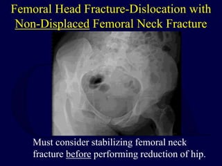 Femoral Head Fracture-Dislocation with
Non-Displaced Femoral Neck Fracture
Must consider stabilizing femoral neck
fracture before performing reduction of hip.
 