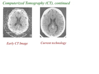 Computerized Tomography (CT), continued
Early CT Image Current technology
 