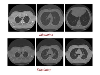 Exhalation
Inhalation
 