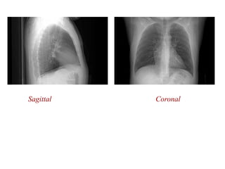 Sagittal Coronal
 