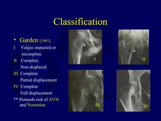 L02 femoral neck fx | PPT