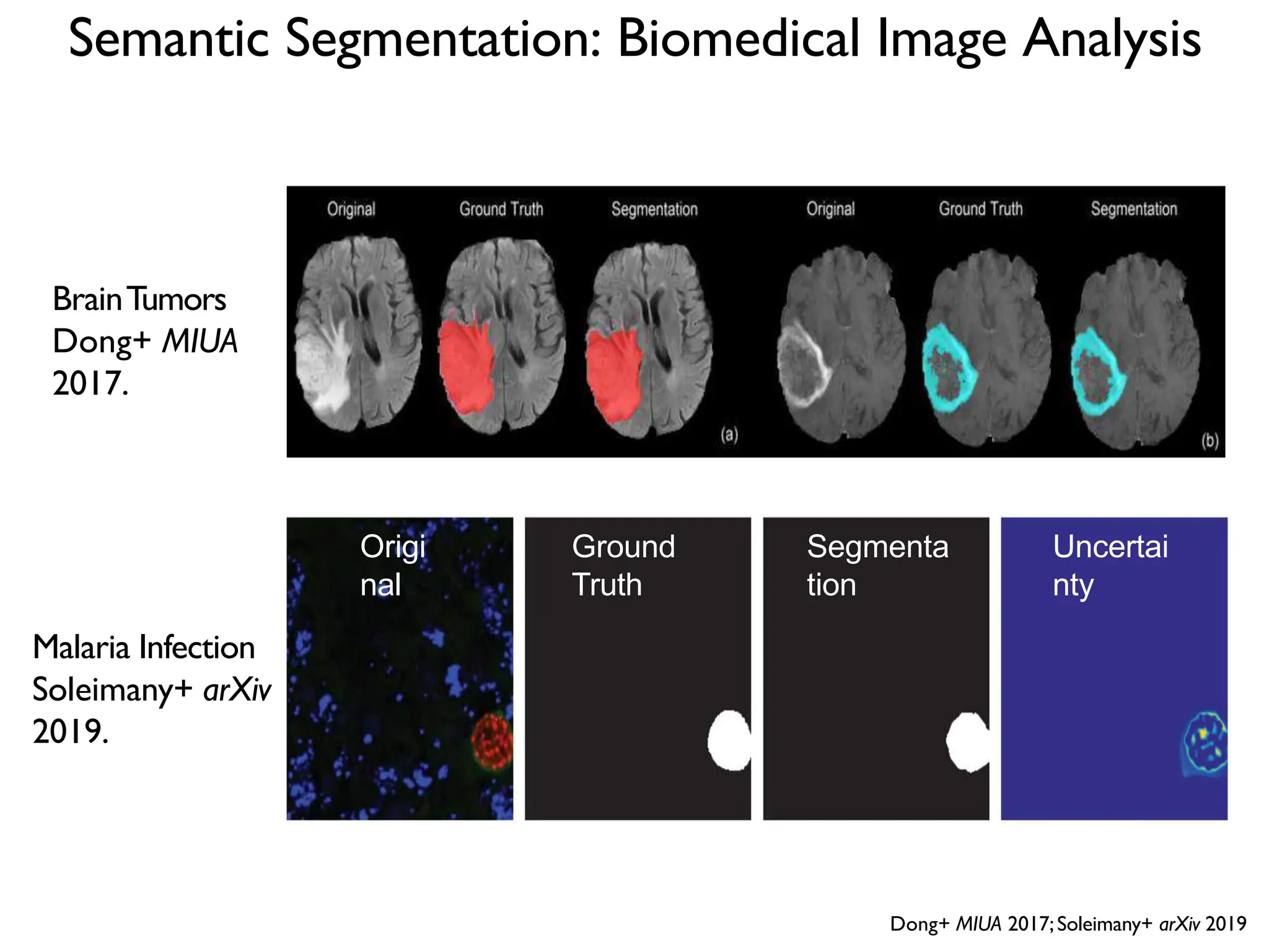 Semantic Segmentation: Biomedical Image Analysis BrainTumors Dong+ MIUA 2017. Malaria Infection Soleimany+ arXiv 2019. Dong+ MIUA 2017;Soleimany+ arXiv 2019 Origi nal Ground Truth Segmenta tion Uncertai nty 