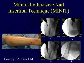 fracture Shaft of femur in lower bone .ppt