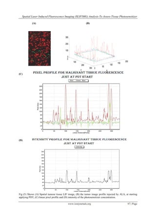 Spatial Laser Induced Fluorescence Imaging (SLIFIMG) Analysis To Assess Tissue Photosensitizer
www.iosrjournals.org 87 | Page
(A) (B)
0
50
100
150
200
0
100
200
300
0
100
200
300
XY
(C)
(D)
Fig (5) Shows (A) Spatial tumour tissue LIF image, (B) the tumor image profile injected by ALA, at starting
applying PDT, (C) linear pixel profile and (D) intensity of the photosensitizer concentration.
 