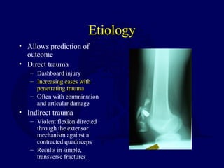 Etiology
• Allows prediction of
outcome
• Direct trauma
– Dashboard injury
– Increasing cases with
penetrating trauma
– Often with comminution
and articular damage
• Indirect trauma
– Violent flexion directed
through the extensor
mechanism against a
contracted quadriceps
– Results in simple,
transverse fractures
 