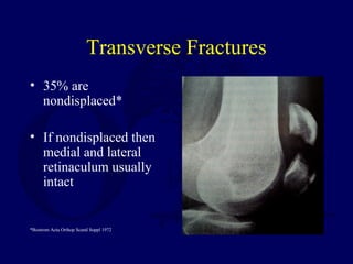 Transverse Fractures
• 35% are
nondisplaced*
• If nondisplaced then
medial and lateral
retinaculum usually
intact
*Bostrom Acta Orthop Scand Suppl 1972
 