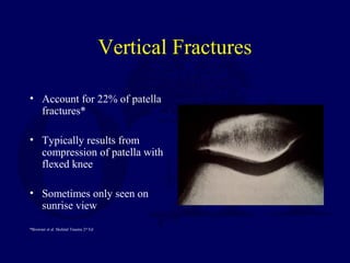 Vertical Fractures
• Account for 22% of patella
fractures*
• Typically results from
compression of patella with
flexed knee
• Sometimes only seen on
sunrise view
*Browner et al. Skeletal Trauma 2nd
Ed
 