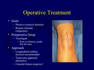 Operative Treatment
• Goals
– Preserve extensor function
– Restore articular
congruency
• Preoperative Setup
– Tourniquet
• Prior to inflation, gently
flex the knee
• Approach
– Longitudinal midline
incision recommended
– Transverse approach
alternative
– Consider future surgeries!
 
