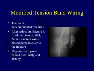 Modified Tension Band Wiring
• Transverse,
noncomminuted fractures
• After reduction, fracture is
fixed with two parallel,
2mm Kirschner wires
placed perpendicular to
the fracture
• 18 gauge wire passed
behind proximally and
distally
 