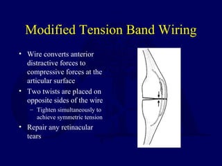 Modified Tension Band Wiring
• Wire converts anterior
distractive forces to
compressive forces at the
articular surface
• Two twists are placed on
opposite sides of the wire
– Tighten simultaneously to
achieve symmetric tension
• Repair any retinacular
tears
 