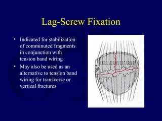 Lag-Screw Fixation
• Indicated for stabilization
of comminuted fragments
in conjunction with
tension band wiring
• May also be used as an
alternative to tension band
wiring for transverse or
vertical fractures
 