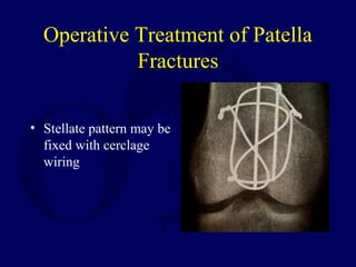 Operative Treatment of Patella
Fractures
• Stellate pattern may be
fixed with cerclage
wiring
 