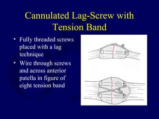 Cannulated Lag-Screw with
Tension Band
• Fully threaded screws
placed with a lag
technique
• Wire through screws
and across anterior
patella in figure of
eight tension band
 