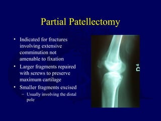 Partial Patellectomy
• Indicated for fractures
involving extensive
comminution not
amenable to fixation
• Larger fragments repaired
with screws to preserve
maximum cartilage
• Smaller fragments excised
– Usually involving the distal
pole
 