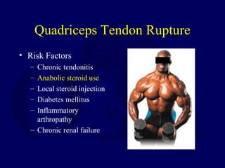 Quadriceps Tendon Rupture
• Risk Factors
– Chronic tendonitis
– Anabolic steroid use
– Local steroid injection
– Diabetes mellitus
– Inflammatory
arthropathy
– Chronic renal failure
 