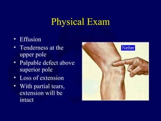 Physical Exam
• Effusion
• Tenderness at the
upper pole
• Palpable defect above
superior pole
• Loss of extension
• With partial tears,
extension will be
intact
 