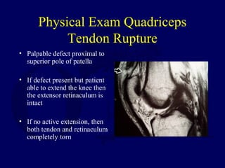 Physical Exam Quadriceps
Tendon Rupture
• Palpable defect proximal to
superior pole of patella
• If defect present but patient
able to extend the knee then
the extensor retinaculum is
intact
• If no active extension, then
both tendon and retinaculum
completely torn
 