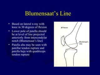 Blumensaat’s Line
• Based on lateral x-ray with
knee in 30 degrees of flexion
• Lower pole of patella should
be at level of line projected
anteriorly from intercondylar
notch (Blumensaat’s line)
• Patella alta may be seen with
patellar tendon rupture and
patella baja with quadriceps
tendon rupture
 