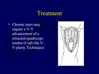 Treatment
• Chronic tears may
require a V-Y
advancement of a
retracted quadriceps
tendon (Codivilla V-
Y-plasty Technique)
 