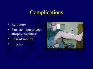 Complications
• Rerupture
• Persistent quadriceps
atrophy/weakness
• Loss of motion
• Infection
 