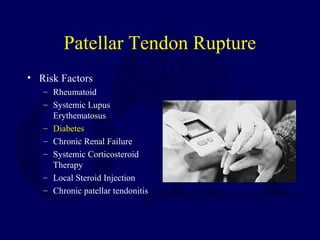 Patellar Tendon Rupture
• Risk Factors
– Rheumatoid
– Systemic Lupus
Erythematosus
– Diabetes
– Chronic Renal Failure
– Systemic Corticosteroid
Therapy
– Local Steroid Injection
– Chronic patellar tendonitis
 