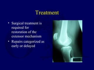 Treatment
• Surgical treatment is
required for
restoration of the
extensor mechanism
• Repairs categorized as
early or delayed
 