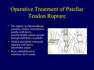Operative Treatment of Patellar
Tendon Rupture
• For rupture at osteotendinous
junction, tendon reattached to
patella with heavy,
nonabsorbable sutures passed
through drill holes in patella
• Medial and lateral retinacula
repaired with heavy
absorbable suture
• Knee immobilized in
extension for 6 weeks
 