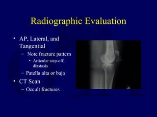 Radiographic Evaluation
• AP, Lateral, and
Tangential
– Note fracture pattern
• Articular step-off,
diastasis
– Patella alta or baja
• CT Scan
– Occult fractures
 