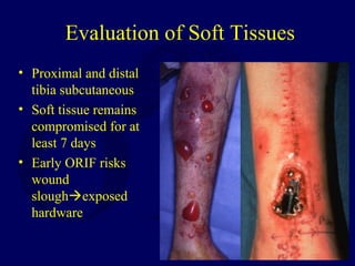 Evaluation of Soft Tissues
• Proximal and distal
tibia subcutaneous
• Soft tissue remains
compromised for at
least 7 days
• Early ORIF risks
wound
sloughexposed
hardware
 