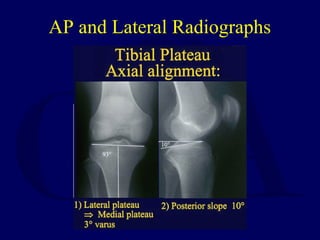 AP and Lateral Radiographs
 
