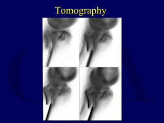 Tomography
 