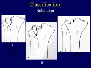 Classification:
Schatzker
I
II
III
 